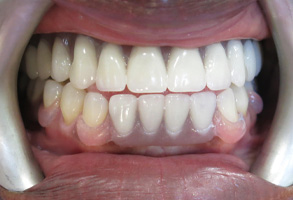 Lodi Family Dentistry | Snoring Appliances, Invisalign reg  and Teeth Whitening