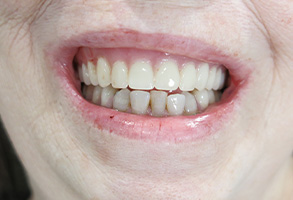 Lodi Family Dentistry | Dentures, Dental Bridges and Solea Laser