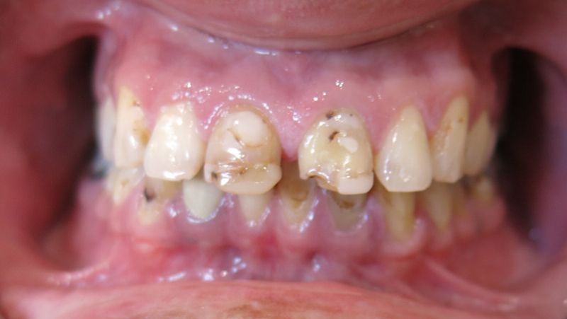 Lodi Family Dentistry | Sedation Dentistry, Sleep Apnea and Night Guards