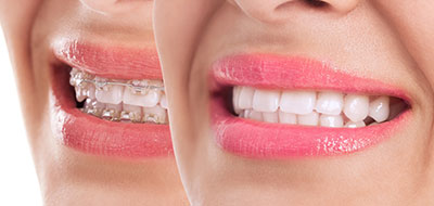 Lodi Family Dentistry | Invisalign reg , Dental Bridges and Pediatric Dentistry