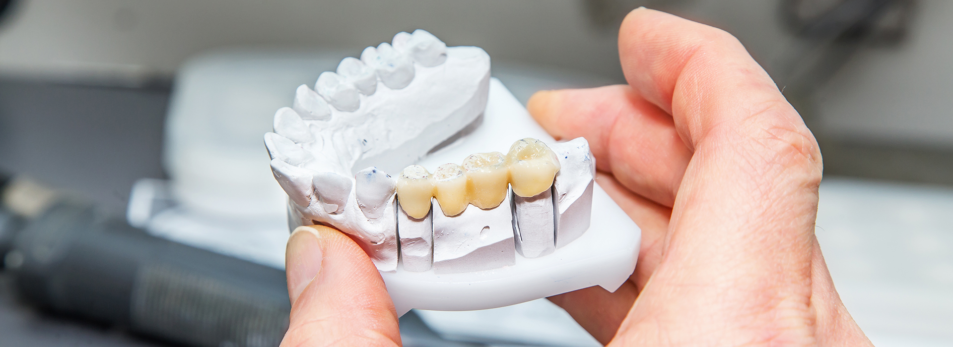 Lodi Family Dentistry | 4-Implant Smile, Oral Exams and Sleep Apnea